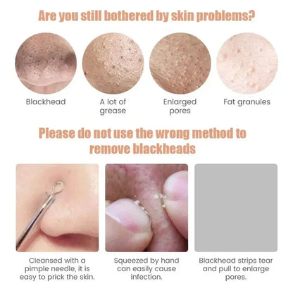 Blueidea Black Head Remover